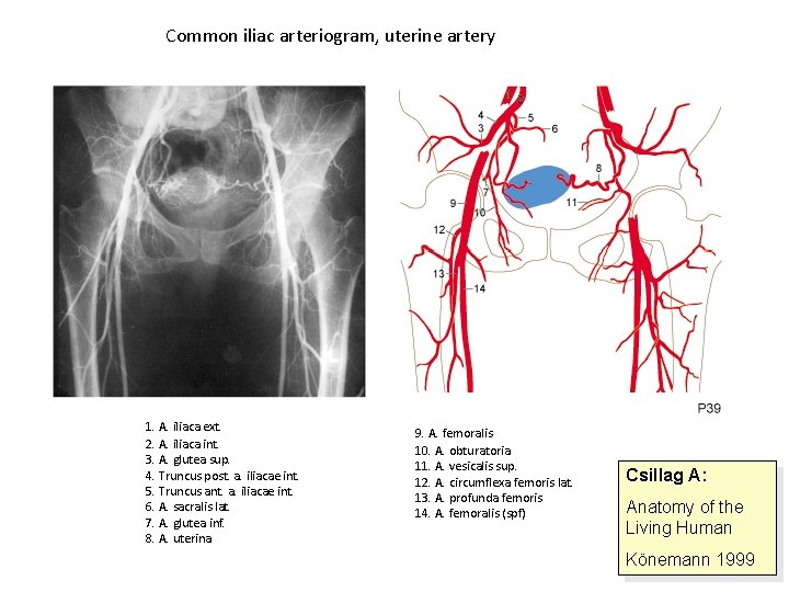 Common iliac arteriogram, uterine artery 1. A. iliaca ext. 2. A. iliaca int. 3.
