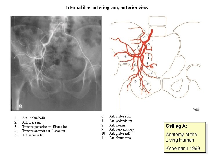 Internal iliac arteriogram, anterior view 1. 2. 3. 4. 5. Art. iliolumbalis Art. iliaca