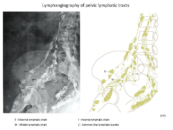 Lymphangiography of pelvic lymphatic tracts E - External lymphatic chain I - Internal lymphatic