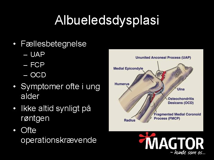Albueledsdysplasi • Fællesbetegnelse – UAP – FCP – OCD • Symptomer ofte i ung