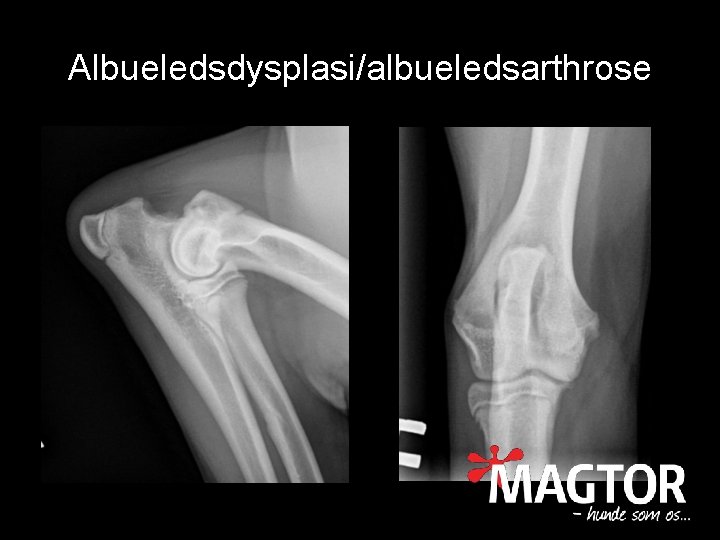 Albueledsdysplasi/albueledsarthrose 