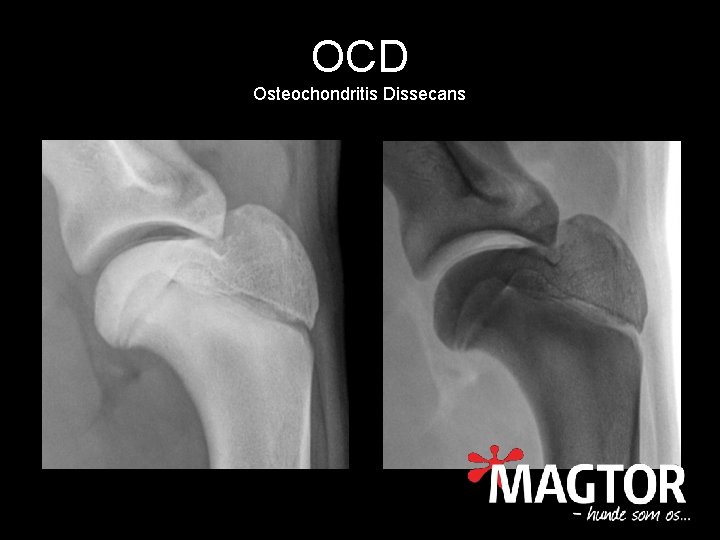 OCD Osteochondritis Dissecans 