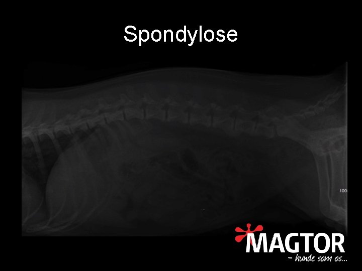 Spondylose 