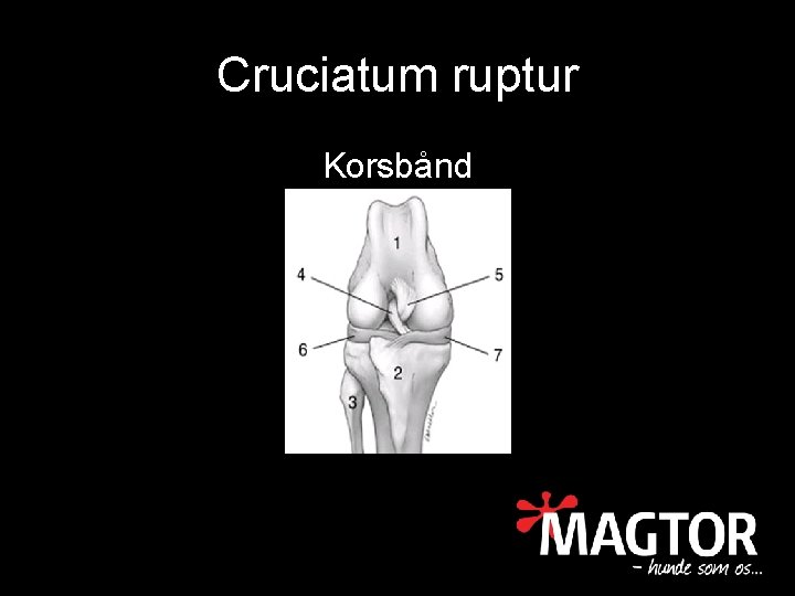 Cruciatum ruptur Korsbånd 