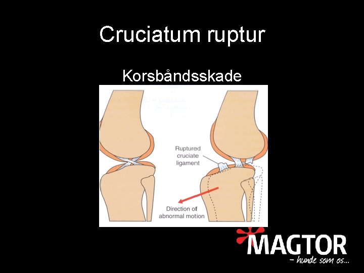 Cruciatum ruptur Korsbåndsskade 