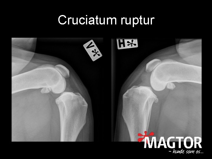 Cruciatum ruptur 