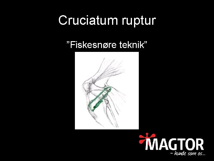 Cruciatum ruptur ”Fiskesnøre teknik” 