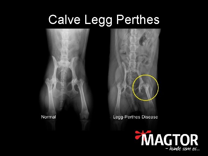 Calve Legg Perthes 