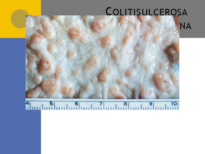 C OLITIS ULCEROSA AMEBIANA 