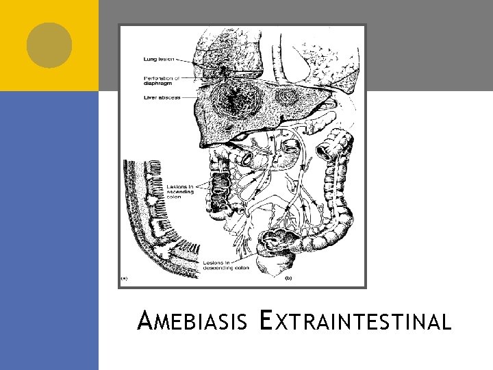 A MEBIASIS E XTRAINTESTINAL 