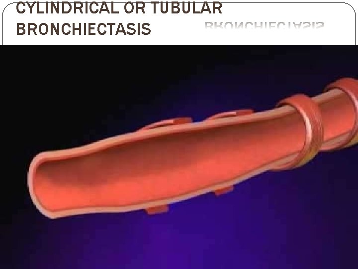 CYLINDRICAL OR TUBULAR BRONCHIECTASIS CYLINDRICAL OR TUBULAR BRONCHIECTASIS