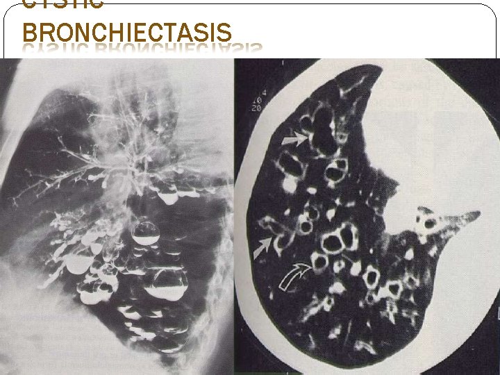 CYSTIC BRONCHIECTASIS CYSTIC BRONCHIECTASIS