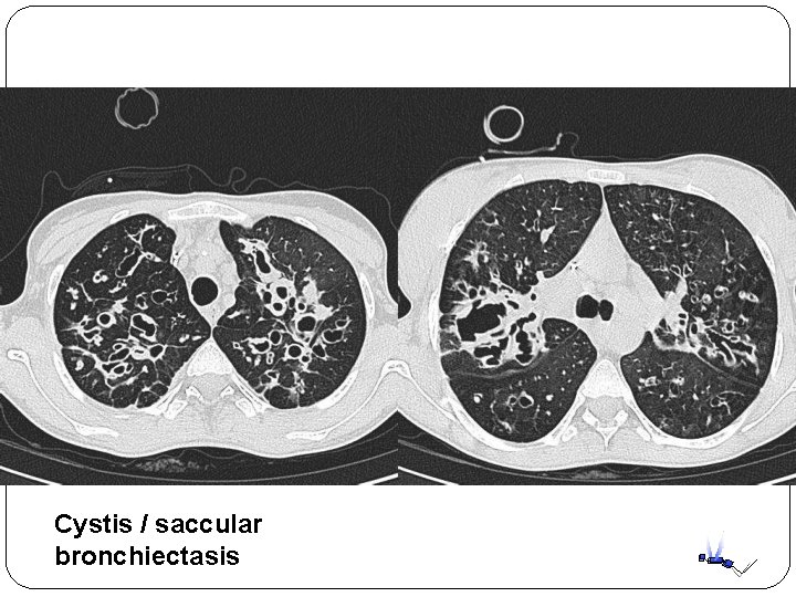Cystis / saccular bronchiectasis Cystis / saccular bronchiectasis