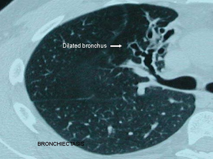 Dilated bronchus BRONCHIECTASIS Dilated bronchus BRONCHIECTASIS