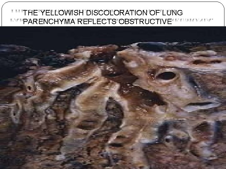 THE YELLOWISH DISCOLORATION OF LUNG PARENCHYMA REFLECTS OBSTRUCTIVE PNEUMONIA. THE YELLOWISH DISCOLORATION OF LUNG PARENCHYMA REFLECTS OBSTRUCTIVE PNEUMONIA.