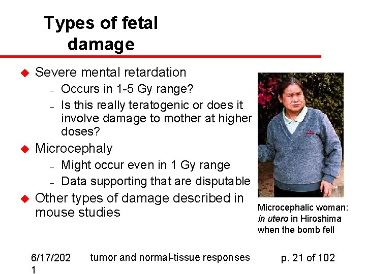Types of fetal damage u Severe mental retardation – – u Microcephaly – –