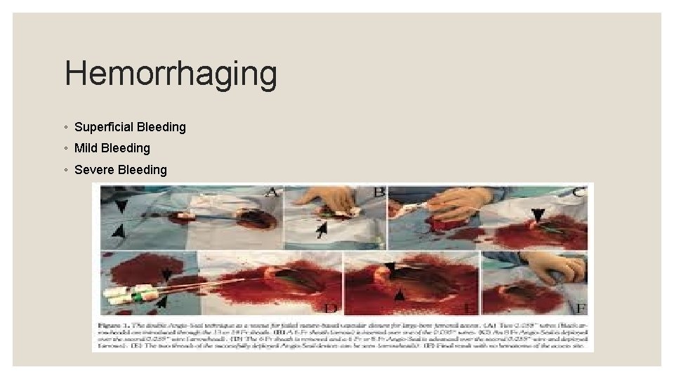 Hemorrhaging ◦ Superficial Bleeding ◦ Mild Bleeding ◦ Severe Bleeding 