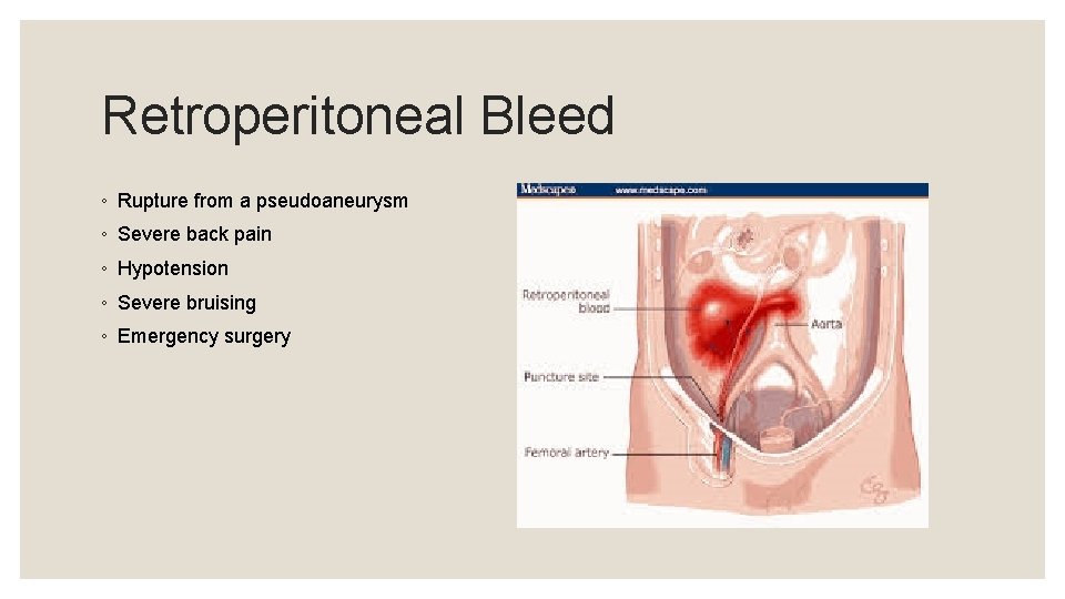Retroperitoneal Bleed ◦ Rupture from a pseudoaneurysm ◦ Severe back pain ◦ Hypotension ◦