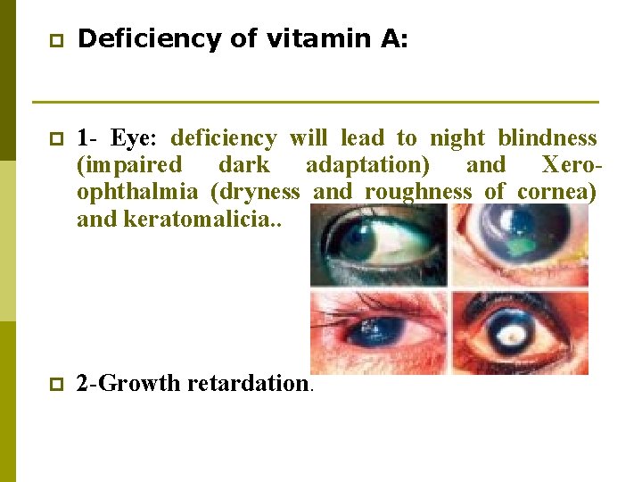 p Deficiency of vitamin A: p 1 - Eye: deficiency will lead to night p Deficiency of vitamin A: p 1 - Eye: deficiency will lead to night