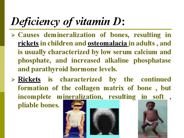 Deficiency of vitamin D: Ø Ø Causes demineralization of bones, resulting in rickets in Deficiency of vitamin D: Ø Ø Causes demineralization of bones, resulting in rickets in