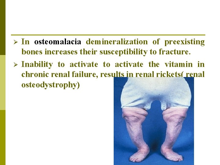 Ø Ø In osteomalacia demineralization of preexisting bones increases their susceptibility to fracture. Inability Ø Ø In osteomalacia demineralization of preexisting bones increases their susceptibility to fracture. Inability