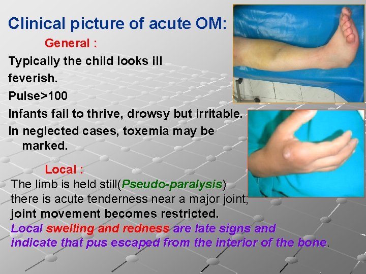 Clinical picture of acute OM: General : Typically the child looks ill feverish. Pulse>100