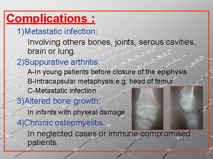 Complications : 1)Metastatic infection: Involving others bones, joints, serous cavities, brain or lung. 2)Suppurative