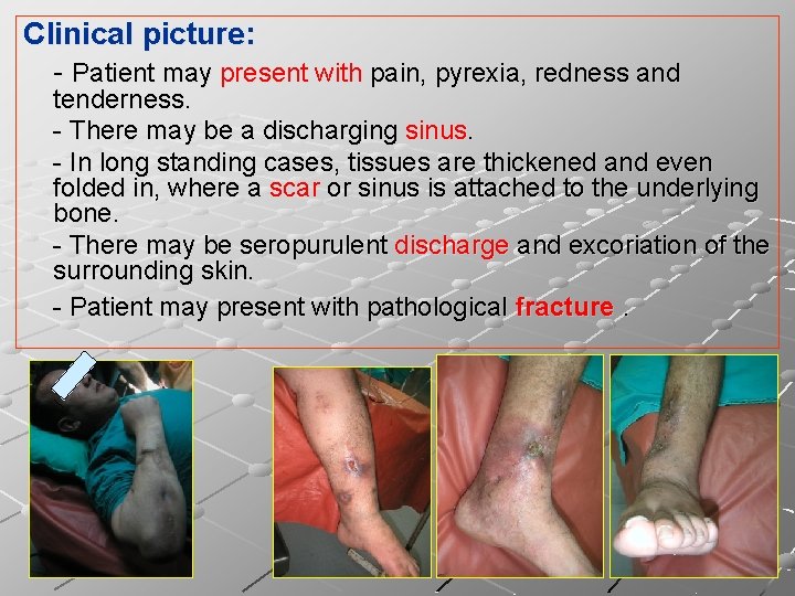 Clinical picture: - Patient may present with pain, pyrexia, redness and tenderness. - There