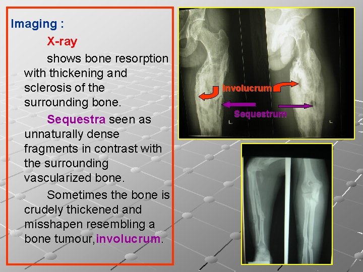 Imaging : X-ray shows bone resorption with thickening and sclerosis of the surrounding bone.