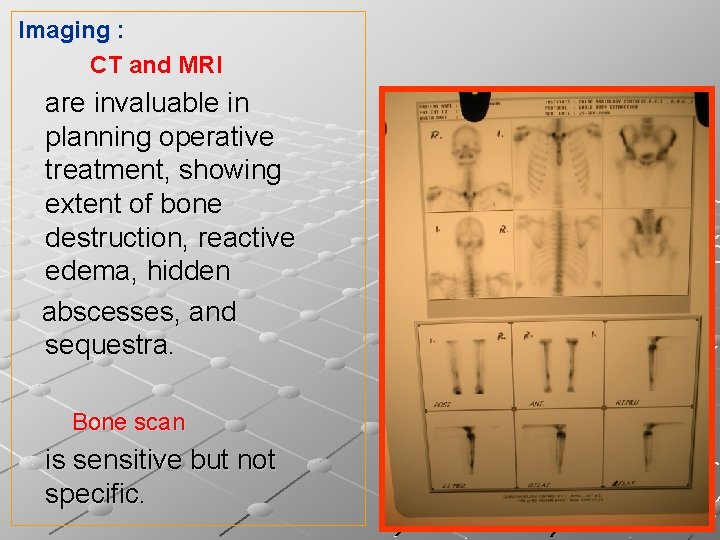 Imaging : CT and MRI are invaluable in planning operative treatment, showing extent of