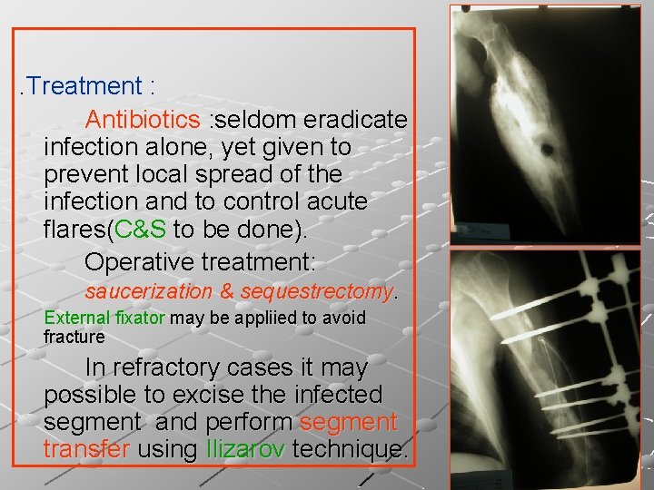 . Treatment : Antibiotics : seldom eradicate infection alone, yet given to prevent local