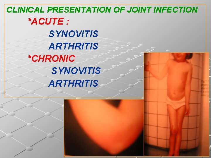 CLINICAL PRESENTATION OF JOINT INFECTION *ACUTE : SYNOVITIS ARTHRITIS *CHRONIC SYNOVITIS ARTHRITIS 