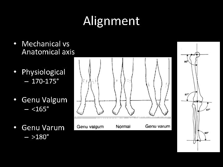 Alignment • Mechanical vs Anatomical axis • Physiological – 170 -175° • Genu Valgum