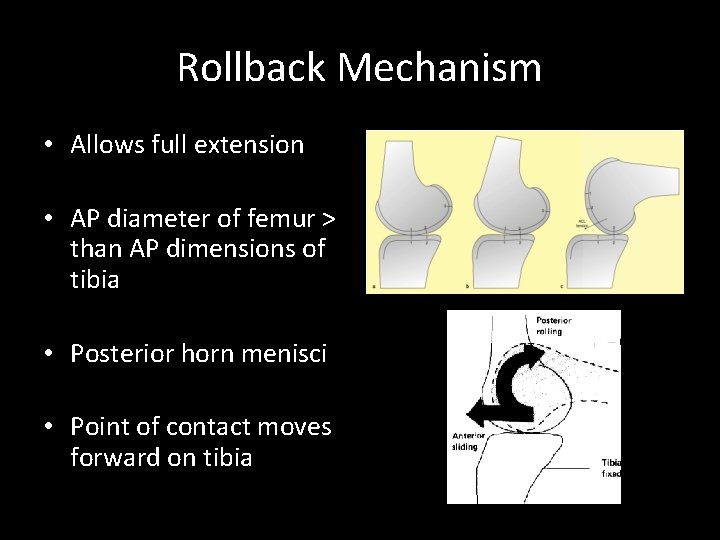 Rollback Mechanism • Allows full extension • AP diameter of femur > than AP