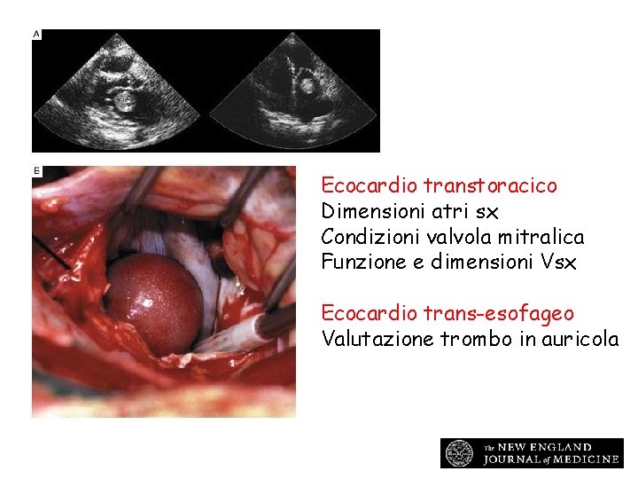 Ecocardio transtoracico Dimensioni atri sx Condizioni valvola mitralica Funzione e dimensioni Vsx Ecocardio trans-esofageo