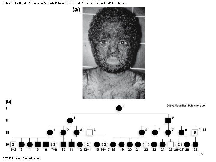 Figure 3. 25 a Congenital generalized hypertrichosis (CGH), an X-linked dominant trait in humans.