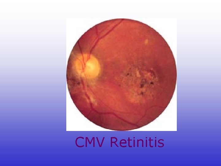 CMV Retinitis 