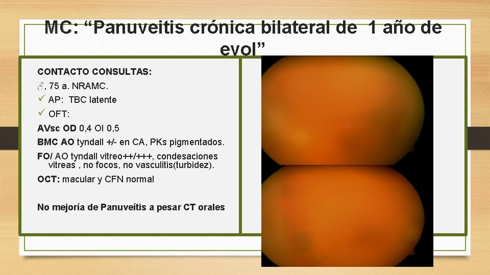 MC: “Panuveitis crónica bilateral de 1 año de evol” CONTACTO CONSULTAS: ♂, 75 a.
