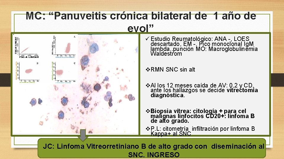 MC: “Panuveitis crónica bilateral de 1 año de evol” ü Estudio Reumatológico: ANA -,