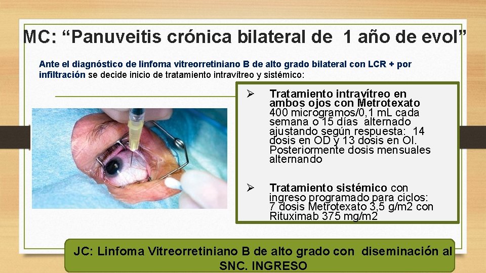 MC: “Panuveitis crónica bilateral de 1 año de evol” Ante el diagnóstico de linfoma