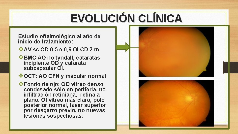 EVOLUCIÓN CLÍNICA Estudio oftalmológico al año de inicio de tratamiento: v. AV sc OD
