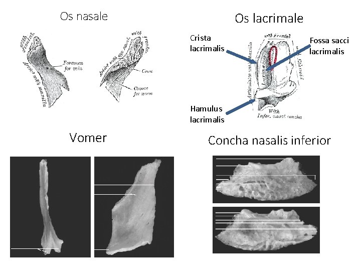 Os nasale Os lacrimale Crista lacrimalis Fossa sacci lacrimalis Hamulus lacrimalis Vomer Concha nasalis