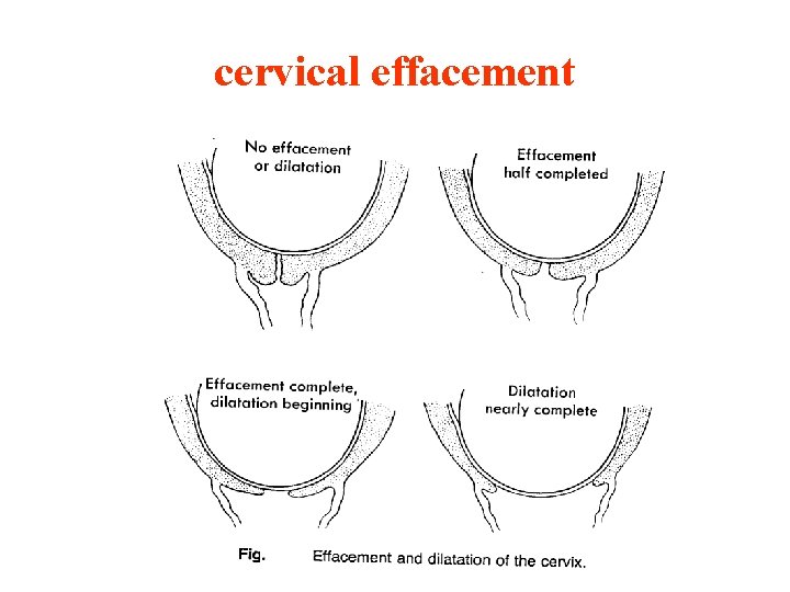 cervical effacement 