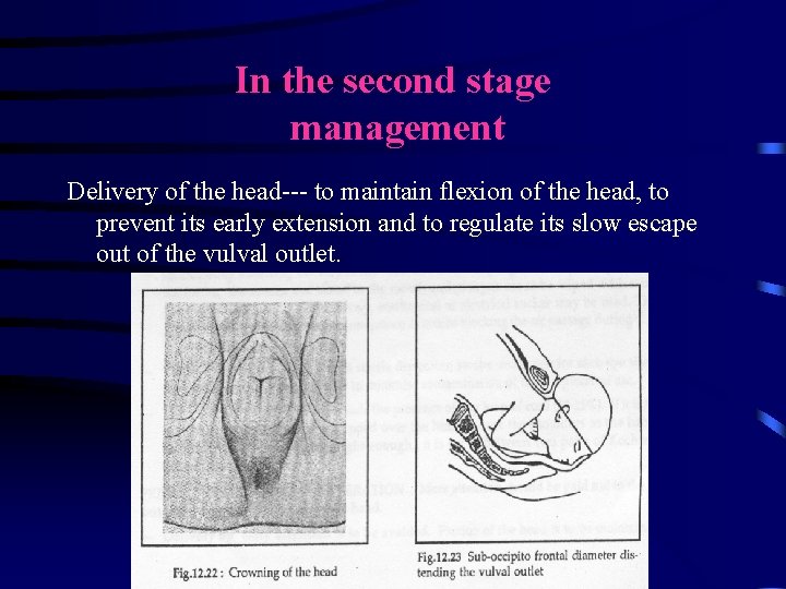 In the second stage management Delivery of the head--- to maintain flexion of the