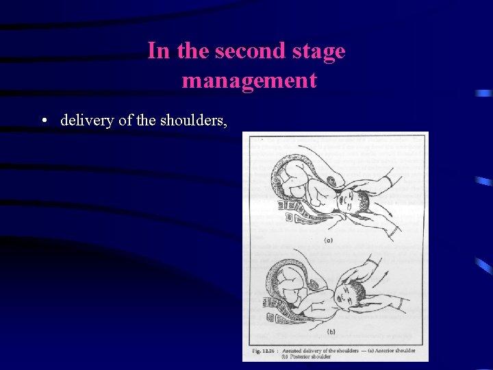 In the second stage management • delivery of the shoulders, 