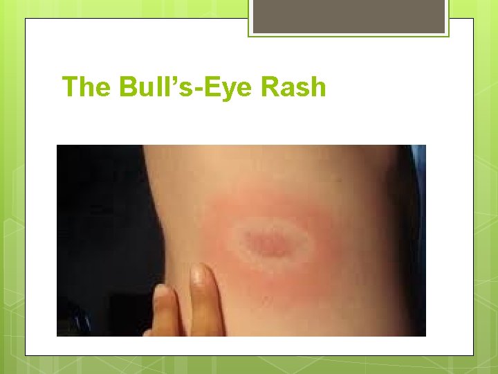 The Bull’s-Eye Rash 