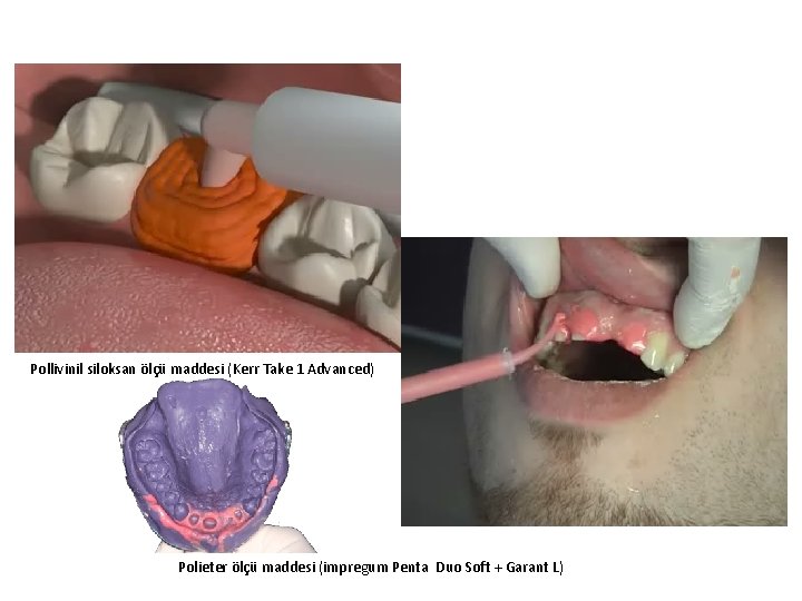 Tek aşamalı çift fazlı ölçü tekniği Pollivinil siloksan ölçü maddesi (Kerr Take 1 Advanced)