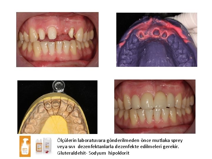 Ölçülerin laboratuvara gönderilmeden önce mutlaka sprey veya sıvı dezenfektanlarla dezenfekte edilmeleri gerekir. Gluteraldehit- Sodyum