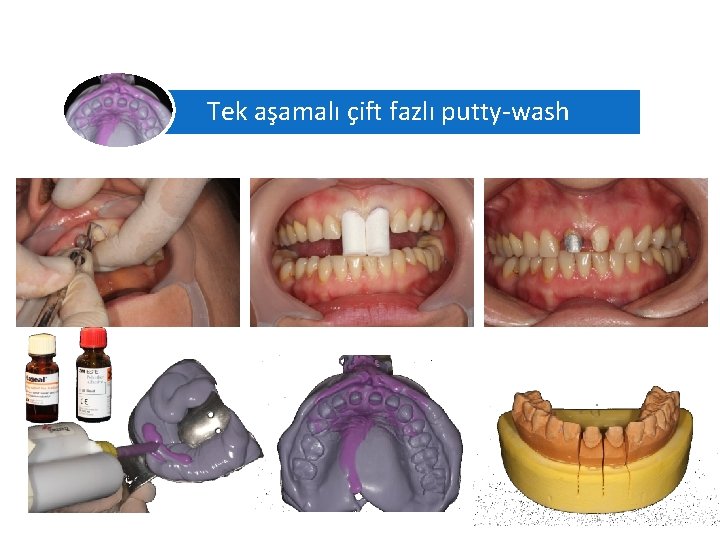 Ölçü Teknikleri Tek aşamalı çift fazlı putty-wash A silikon ölçü maddesi 