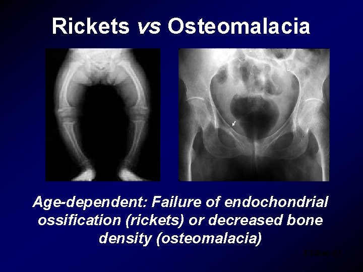 Rickets vs Osteomalacia Age-dependent: Failure of endochondrial ossification (rickets) or decreased bone density (osteomalacia)